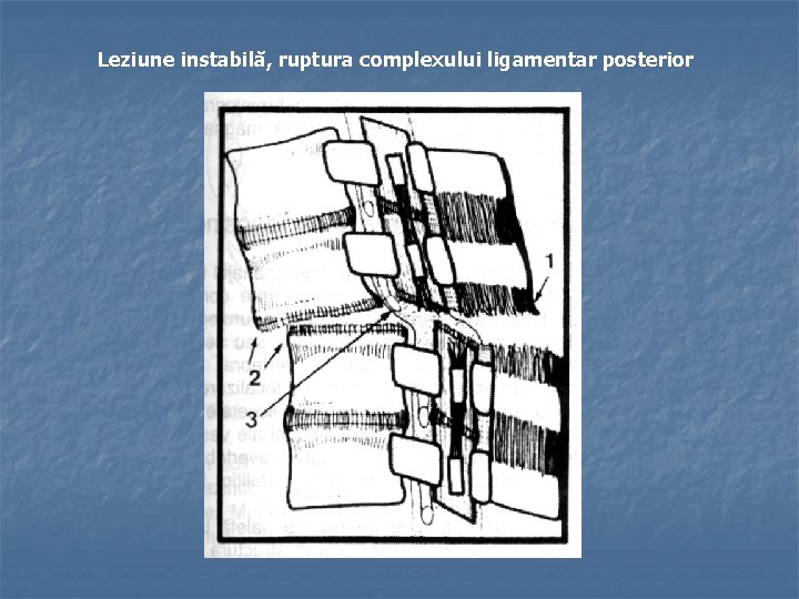 Leziune instabilă, ruptura complexului ligamentar posterior 