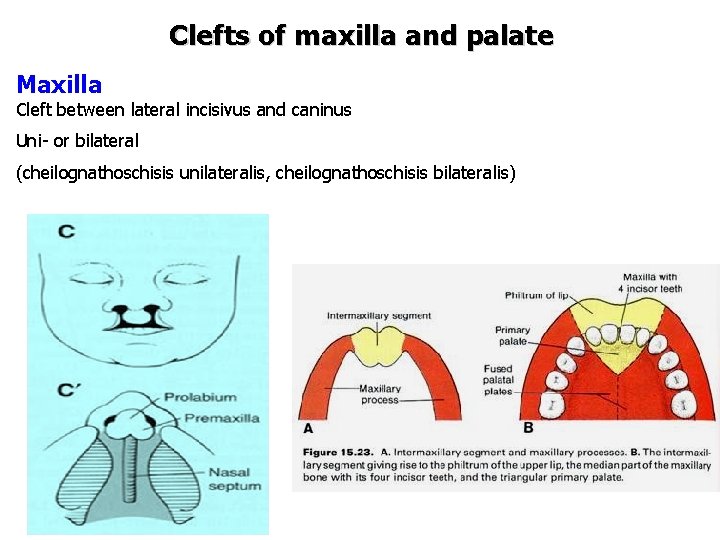Clefts of maxilla and palate Maxilla Cleft between lateral incisivus and caninus Uni- or