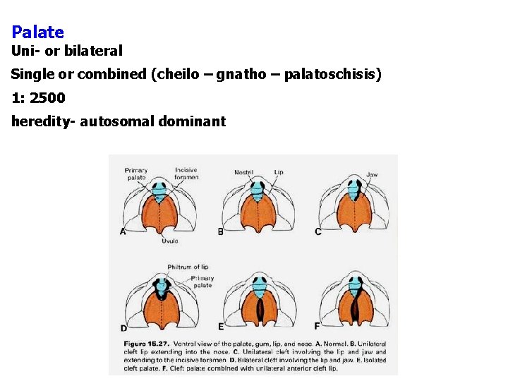 Palate Uni- or bilateral Single or combined (cheilo – gnatho – palatoschisis) 1: 2500