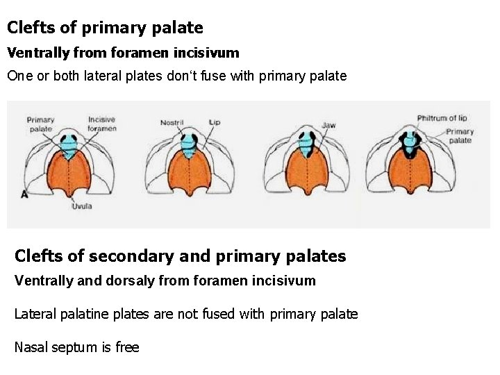 Clefts of primary palate Ventrally from foramen incisivum One or both lateral plates don‘t