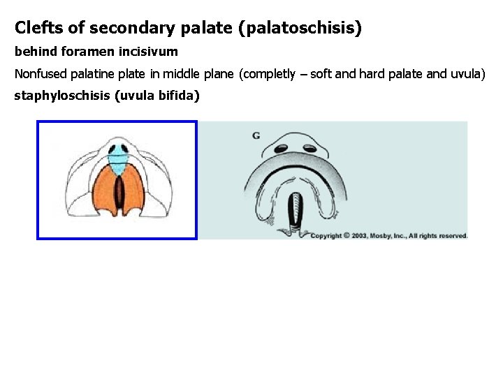 Clefts of secondary palate (palatoschisis) behind foramen incisivum Nonfused palatine plate in middle plane