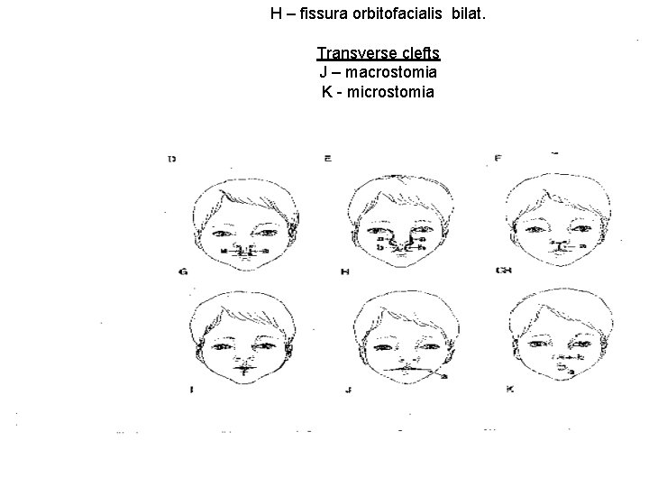 H – fissura orbitofacialis bilat. Transverse clefts J – macrostomia K - microstomia 