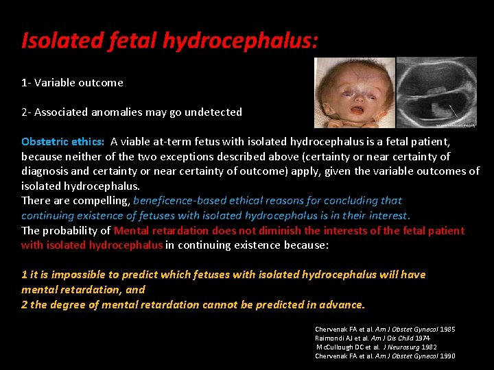 Isolated fetal hydrocephalus: 1 - Variable outcome 2 - Associated anomalies may go undetected