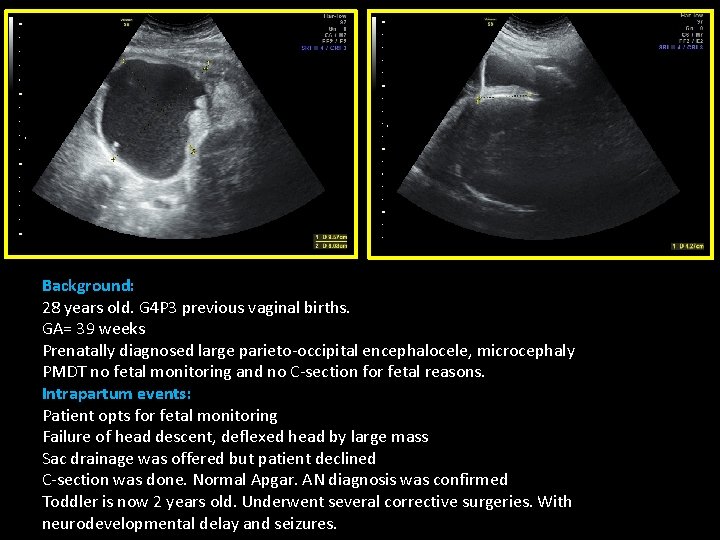 Background: 28 years old. G 4 P 3 previous vaginal births. GA= 39 weeks