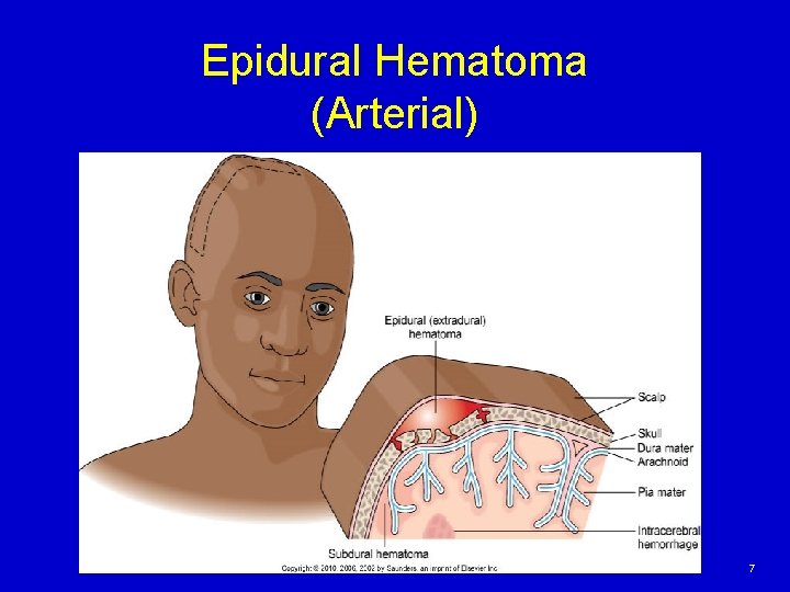 Epidural Hematoma (Arterial) Copyright © 2013, 2010, 2006, 2002 by Saunders, an imprint of