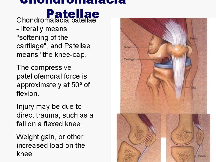 Chondromalacia Patellae Chondromalacia patellae - literally means "softening of the cartilage", and Patellae means
