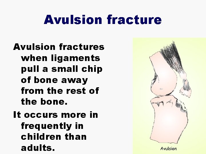 Avulsion fractures when ligaments pull a small chip of bone away from the rest