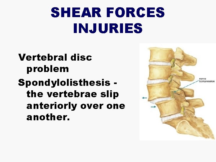 SHEAR FORCES INJURIES Vertebral disc problem Spondylolisthesis the vertebrae slip anteriorly over one another.