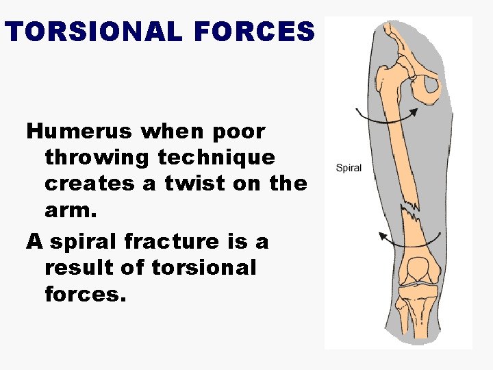 TORSIONAL FORCES Humerus when poor throwing technique creates a twist on the arm. A
