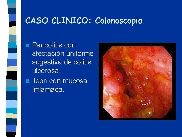 CASO CLINICO: Colonoscopia Pancolitis con afectación uniforme sugestiva de colitis ulcerosa. n Ileon con