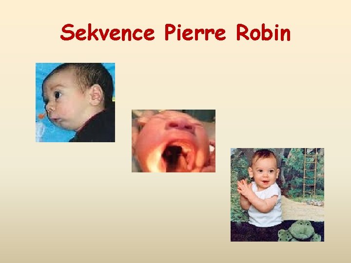 Sekvence Pierre Robin 
