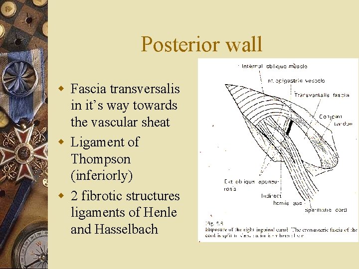 Posterior wall w Fascia transversalis in it’s way towards the vascular sheat w Ligament