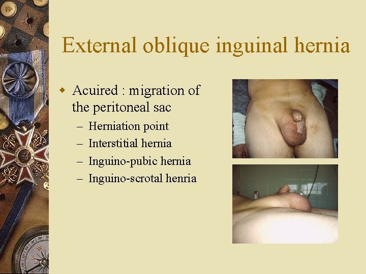 External oblique inguinal hernia w Acuired : migration of the peritoneal sac – –