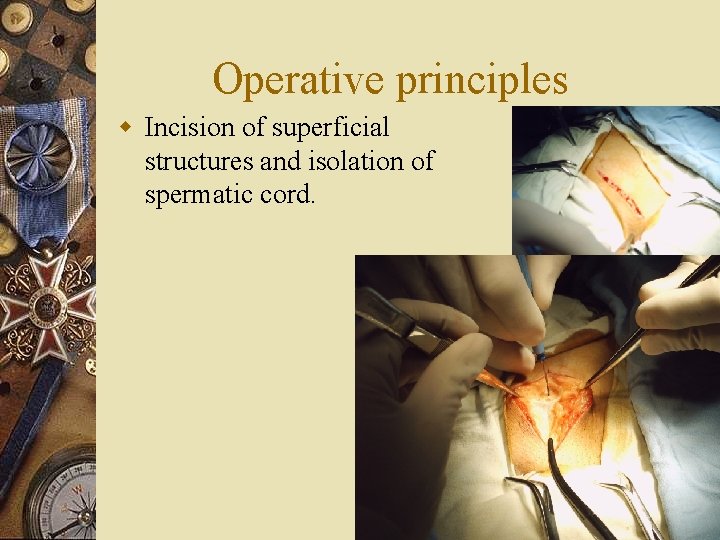 Operative principles w Incision of superficial structures and isolation of spermatic cord. 