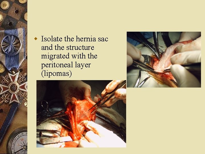 w Isolate the hernia sac and the structure migrated with the peritoneal layer (lipomas)