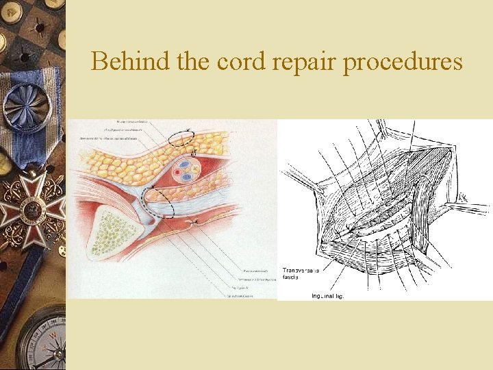 Behind the cord repair procedures 