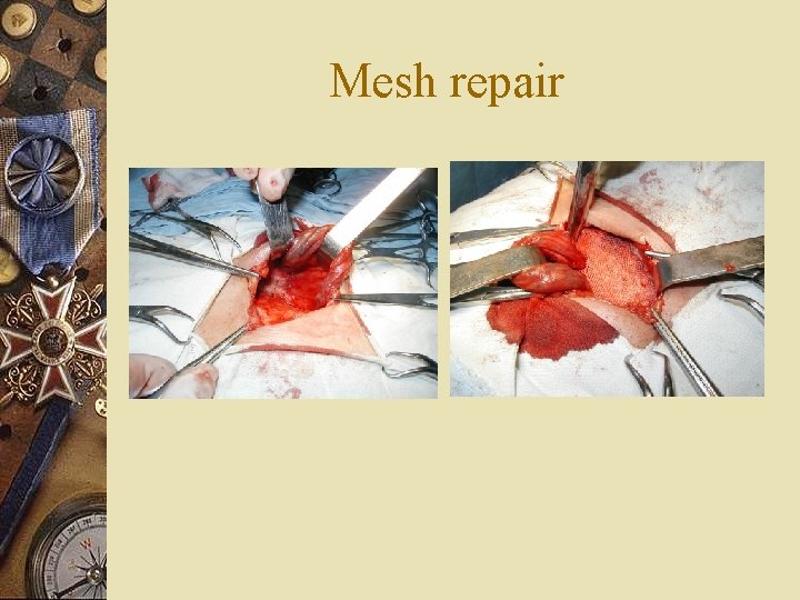 Mesh repair 