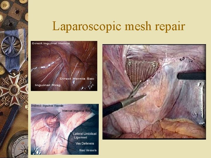 Laparoscopic mesh repair 