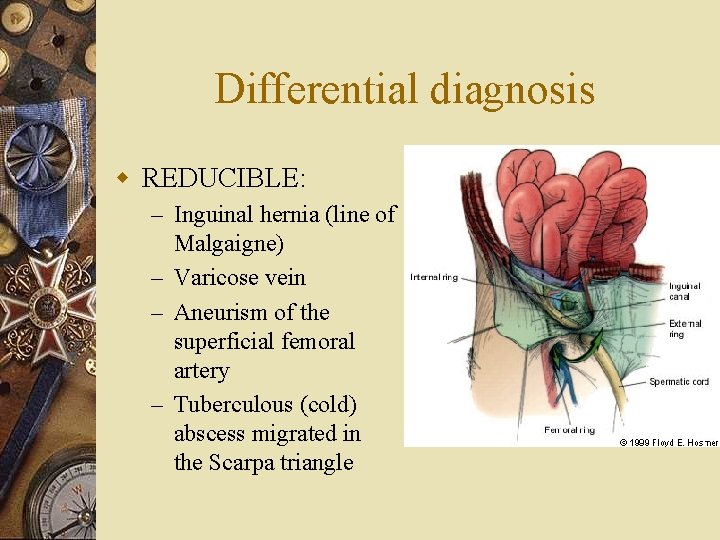 Differential diagnosis w REDUCIBLE: – Inguinal hernia (line of Malgaigne) – Varicose vein –