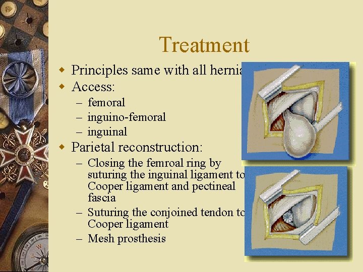 Treatment w Principles same with all hernia w Access: – femoral – inguino-femoral –