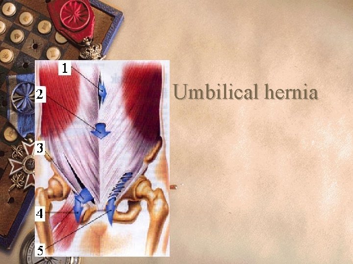 Umbilical hernia 