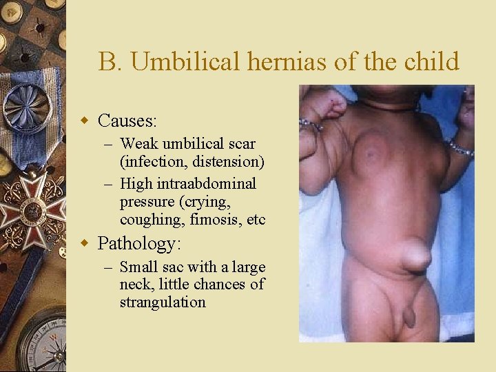 B. Umbilical hernias of the child w Causes: – Weak umbilical scar (infection, distension)