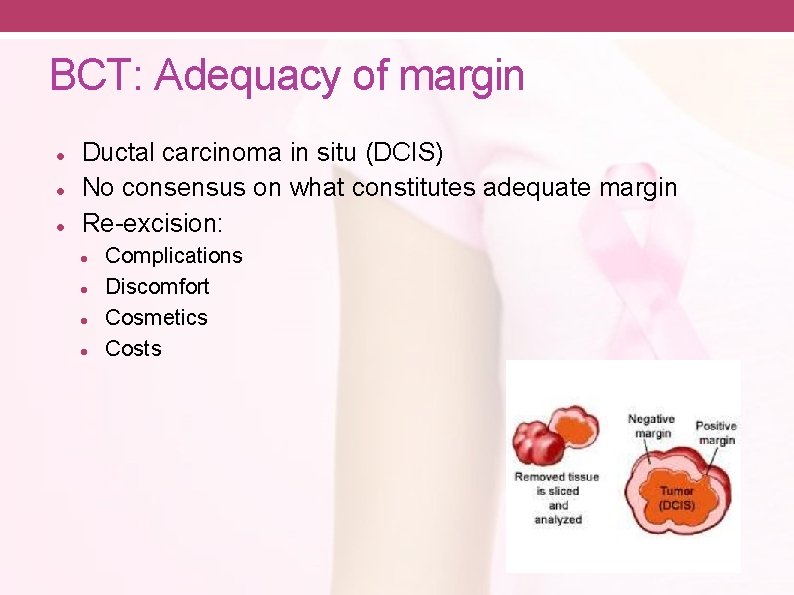 BCT: Adequacy of margin Ductal carcinoma in situ (DCIS) No consensus on what constitutes
