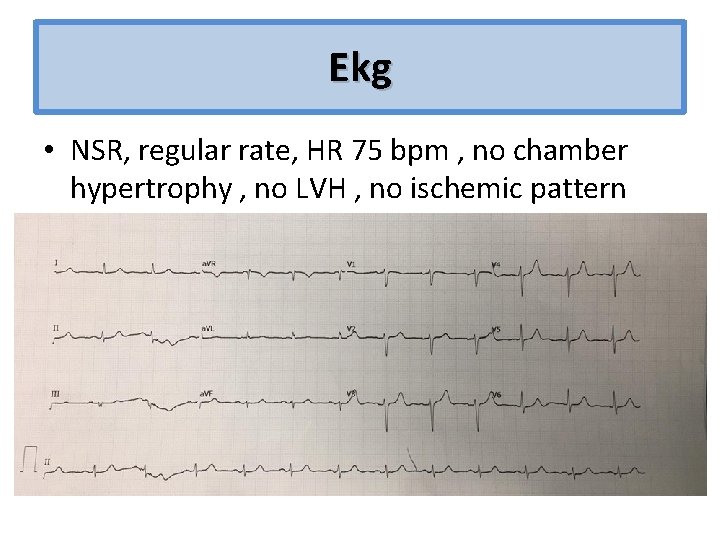 Ekg • NSR, regular rate, HR 75 bpm , no chamber hypertrophy , no