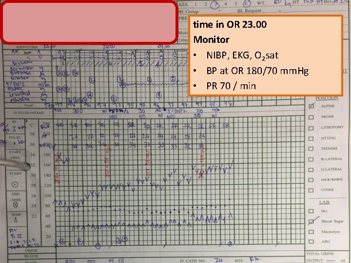 time in OR 23. 00 Monitor • NIBP, EKG, O 2 sat • BP