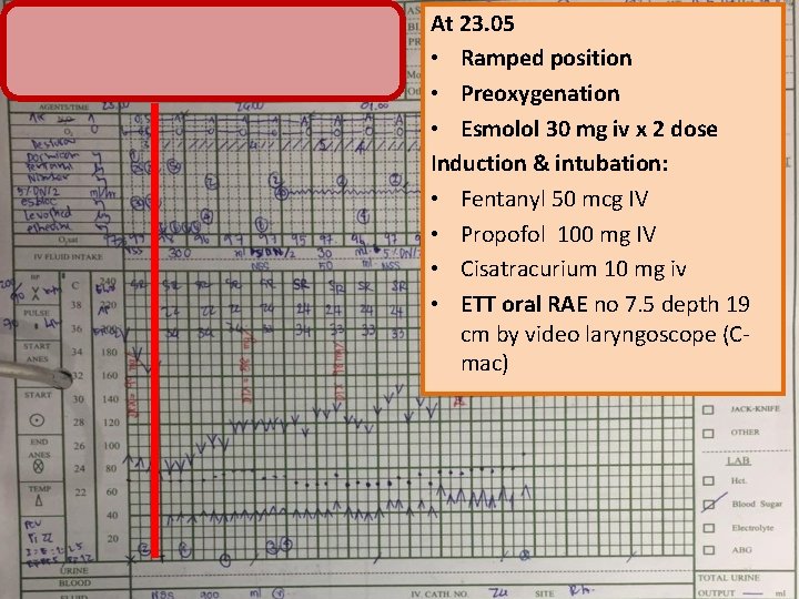 At 23. 05 • Ramped position • Preoxygenation • Esmolol 30 mg iv x