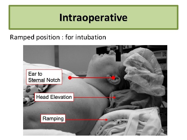 Intraoperative Ramped position : for intubation 