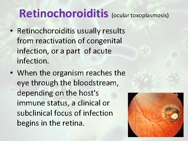 Retinochoroiditis (ocular toxoplasmosis) • Retinochoroiditis usually results from reactivation of congenital infection, or a