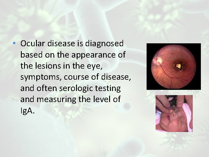  • Ocular disease is diagnosed based on the appearance of the lesions in