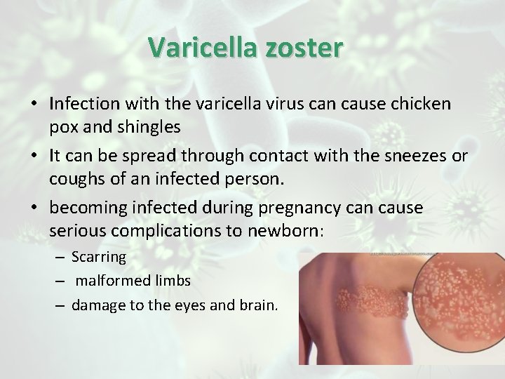 Varicella zoster • Infection with the varicella virus can cause chicken pox and shingles