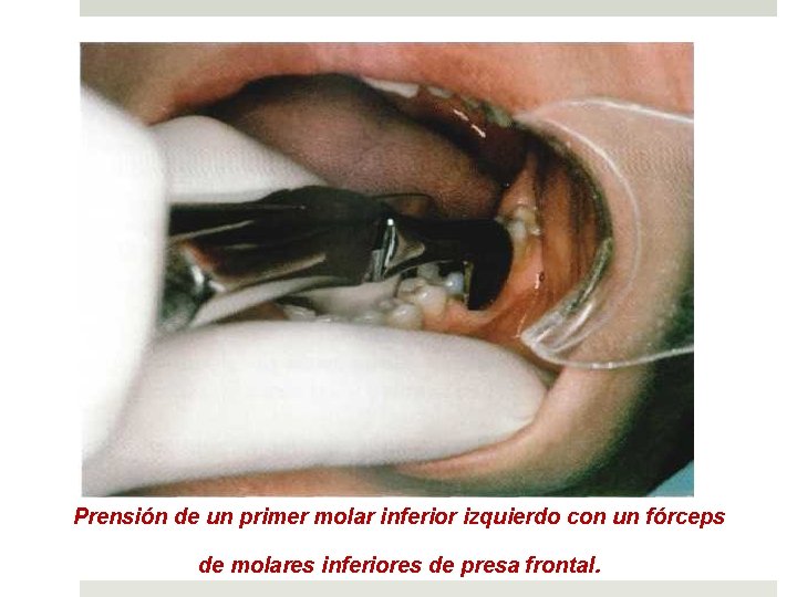 Prensión de un primer molar inferior izquierdo con un fórceps de molares inferiores de