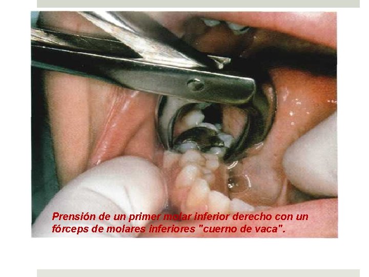 Prensión de un primer molar inferior derecho con un fórceps de molares inferiores "cuerno