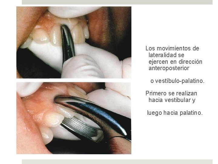 Los movimientos de lateralidad se ejercen en dirección anteroposterior o vestíbulo-palatino. Primero se realizan