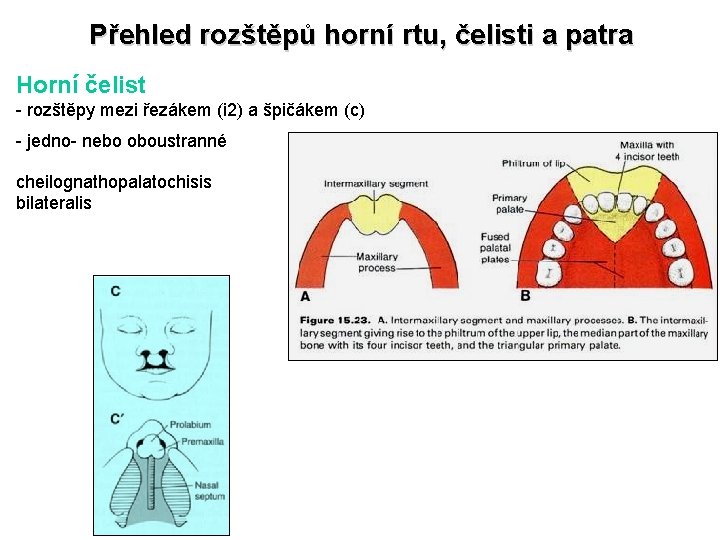 Přehled rozštěpů horní rtu, čelisti a patra Horní čelist - rozštěpy mezi řezákem (i