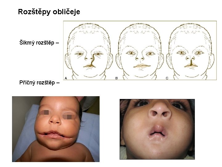 Rozštěpy obličeje Šikmý rozštěp – Příčný rozštěp – 