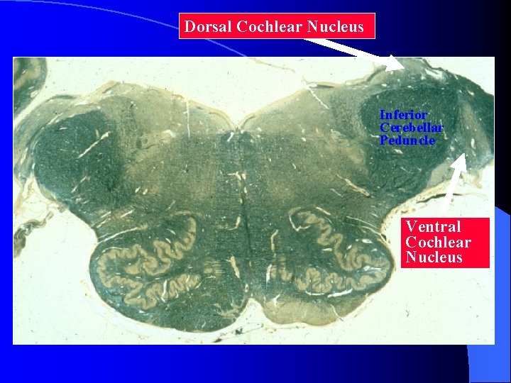 Dorsal Cochlear Nucleus Inferior Cerebellar Peduncle Ventral Cochlear Nucleus 