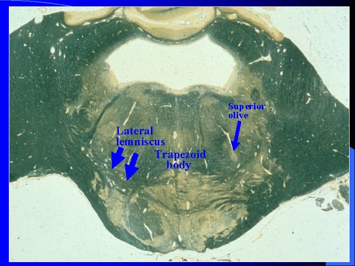 Superior olive Lateral lemniscus Trapezoid body 