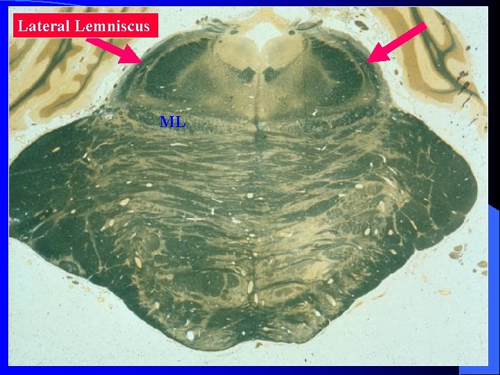 Lateral Lemniscus ML 