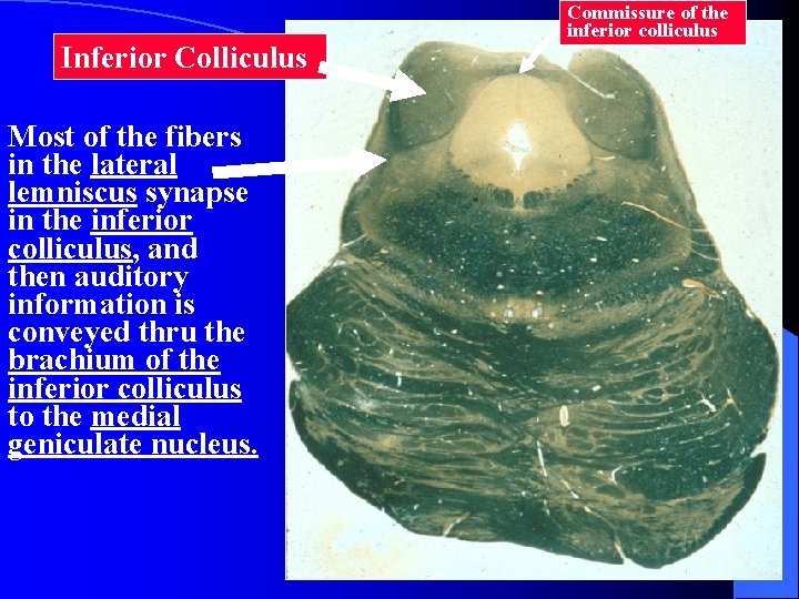 Inferior Colliculus Most of the fibers in the lateral lemniscus synapse in the inferior