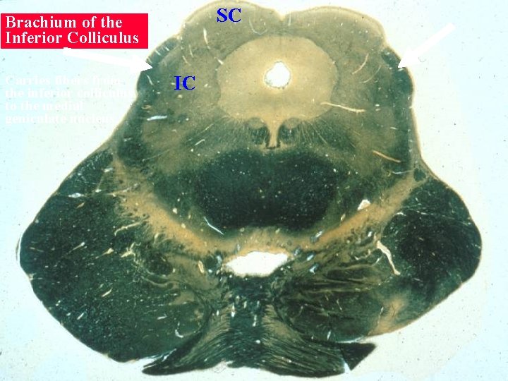 SC Brachium of the Inferior Colliculus Carries fibers from the inferior colliculus to the