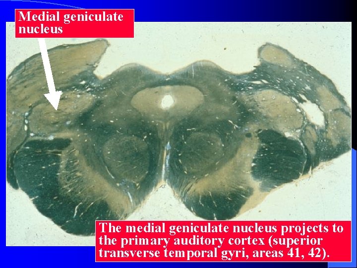 Medial geniculate nucleus The medial geniculate nucleus projects to the primary auditory cortex (superior
