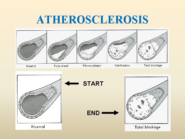 ATHEROSCLEROSIS START END 