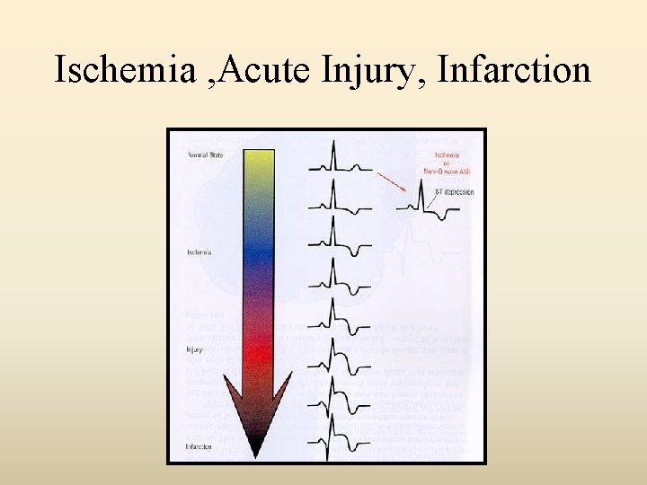 Ischemia , Acute Injury, Infarction 
