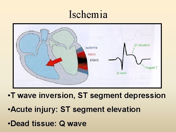 Ischemia • T wave inversion, ST segment depression • Acute injury: ST segment elevation