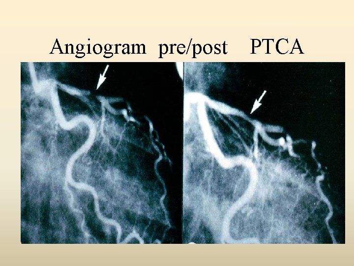 Angiogram pre/post PTCA 