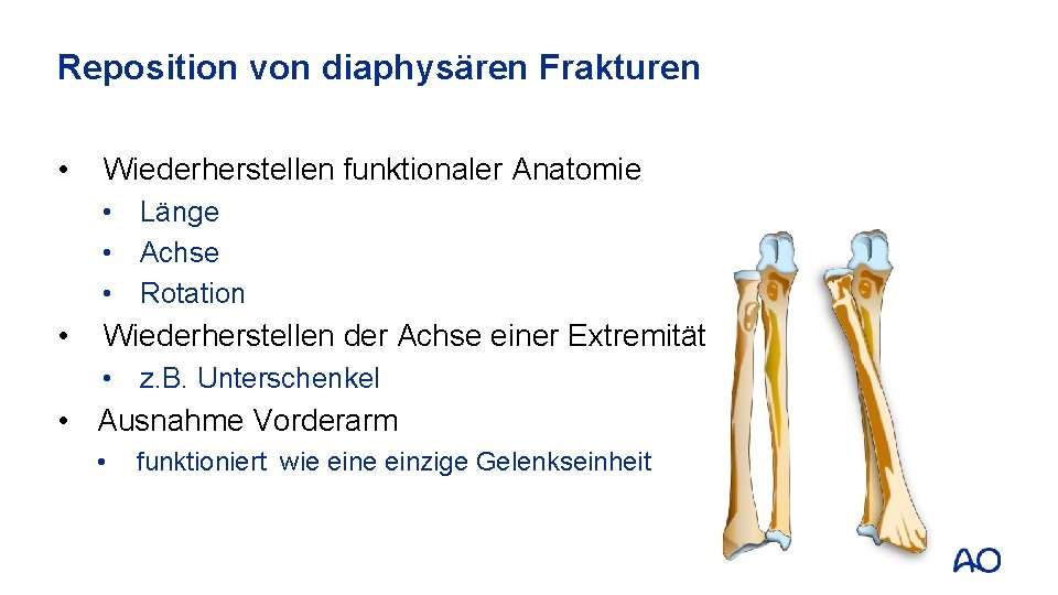 Reposition von diaphysären Frakturen • Wiederherstellen funktionaler Anatomie • Länge • Achse • Rotation